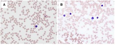 Case Report: Lomustine overdose in a 15-year-old, healthy adolescent—a prescription failure